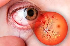 Tratamento de Glaucoma